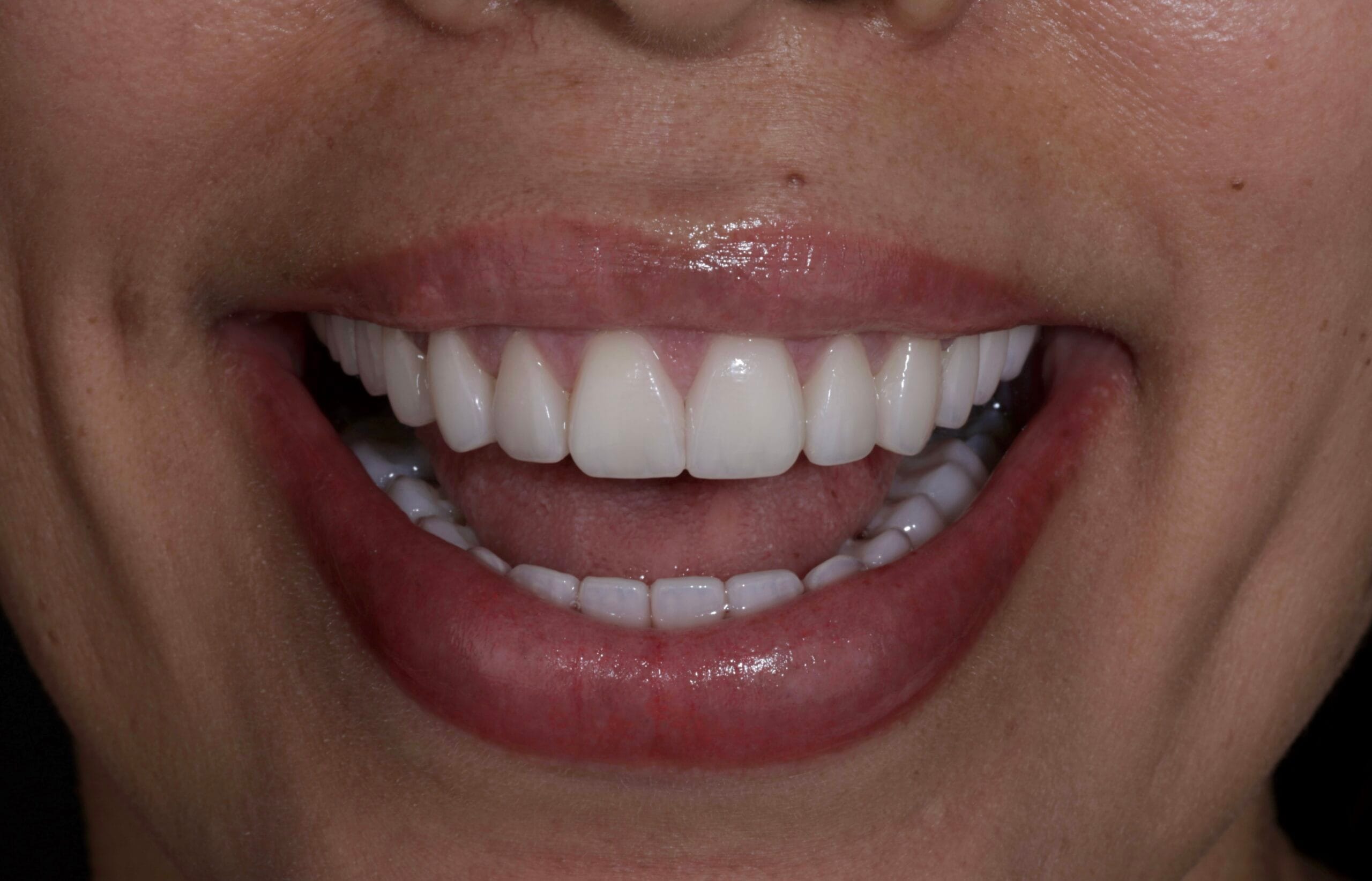 YELLOW TEETH TO PORCELAIN VENEERS