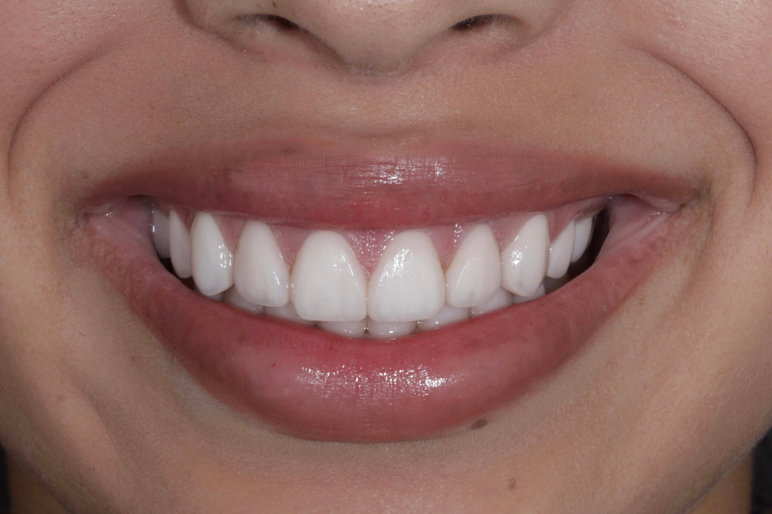 YELLOW TEETH TO PORCELAIN VENEERS