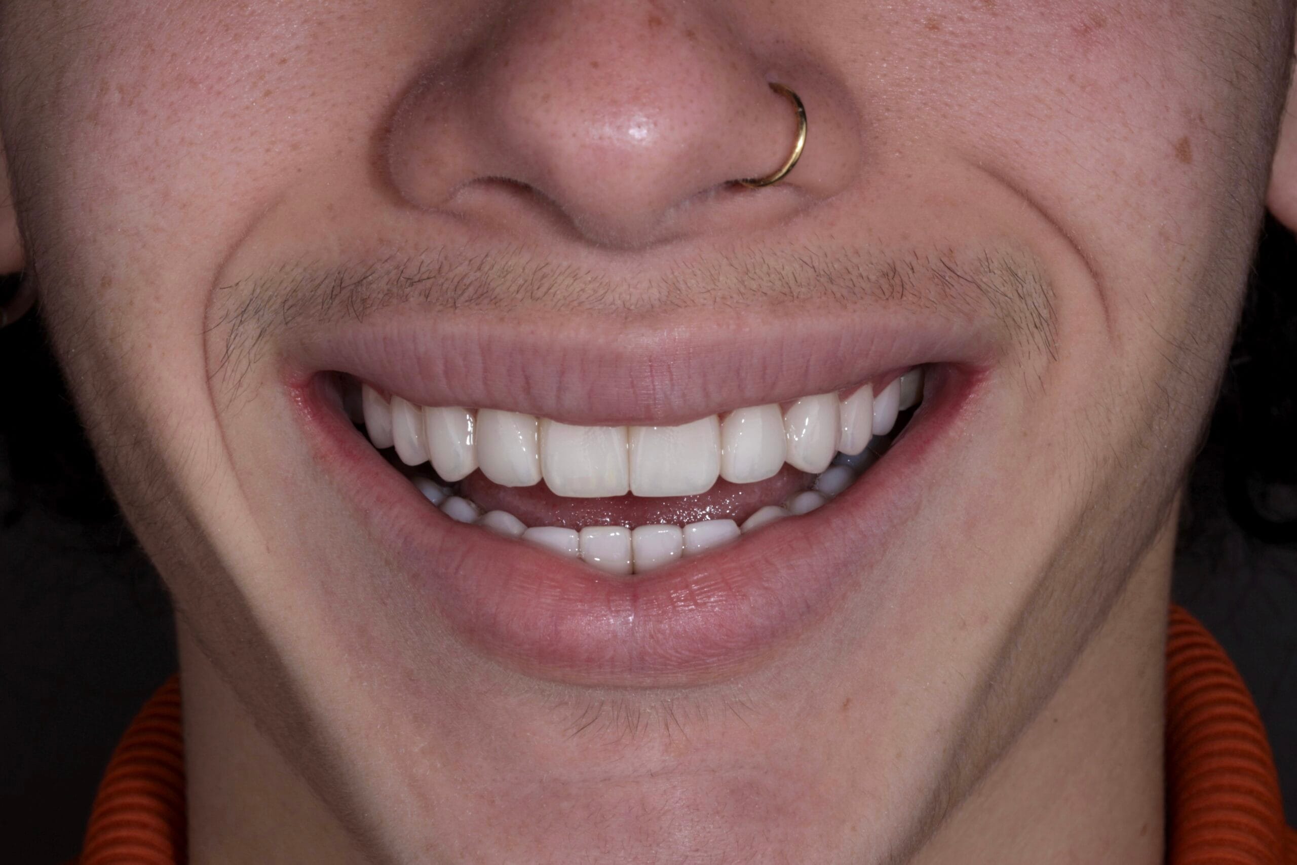 DISCOLORED TEETH TO PORCELAIN VENEERS