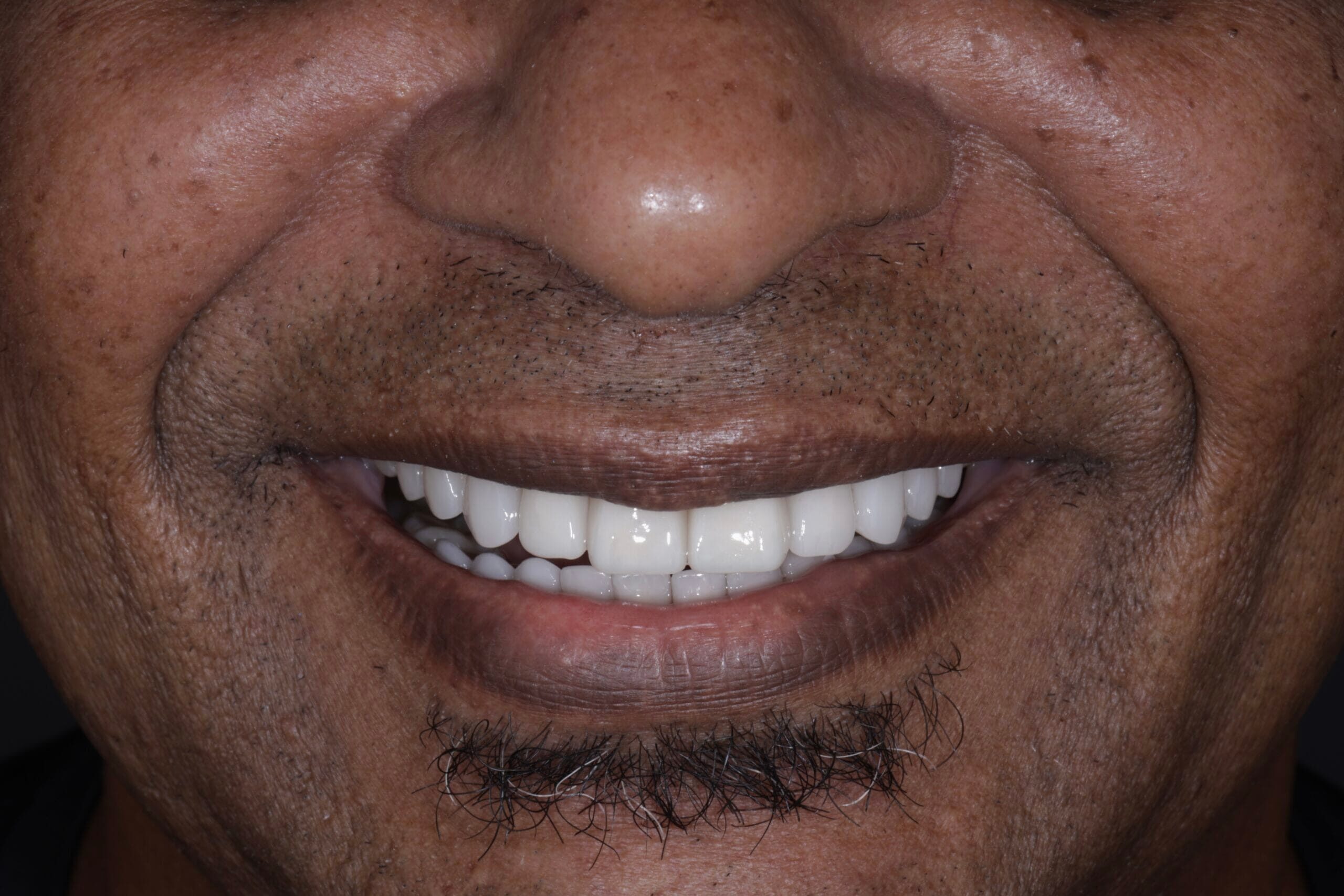 Say no more to dental gaps:                                    Clifton’s journey to a perfect smile.