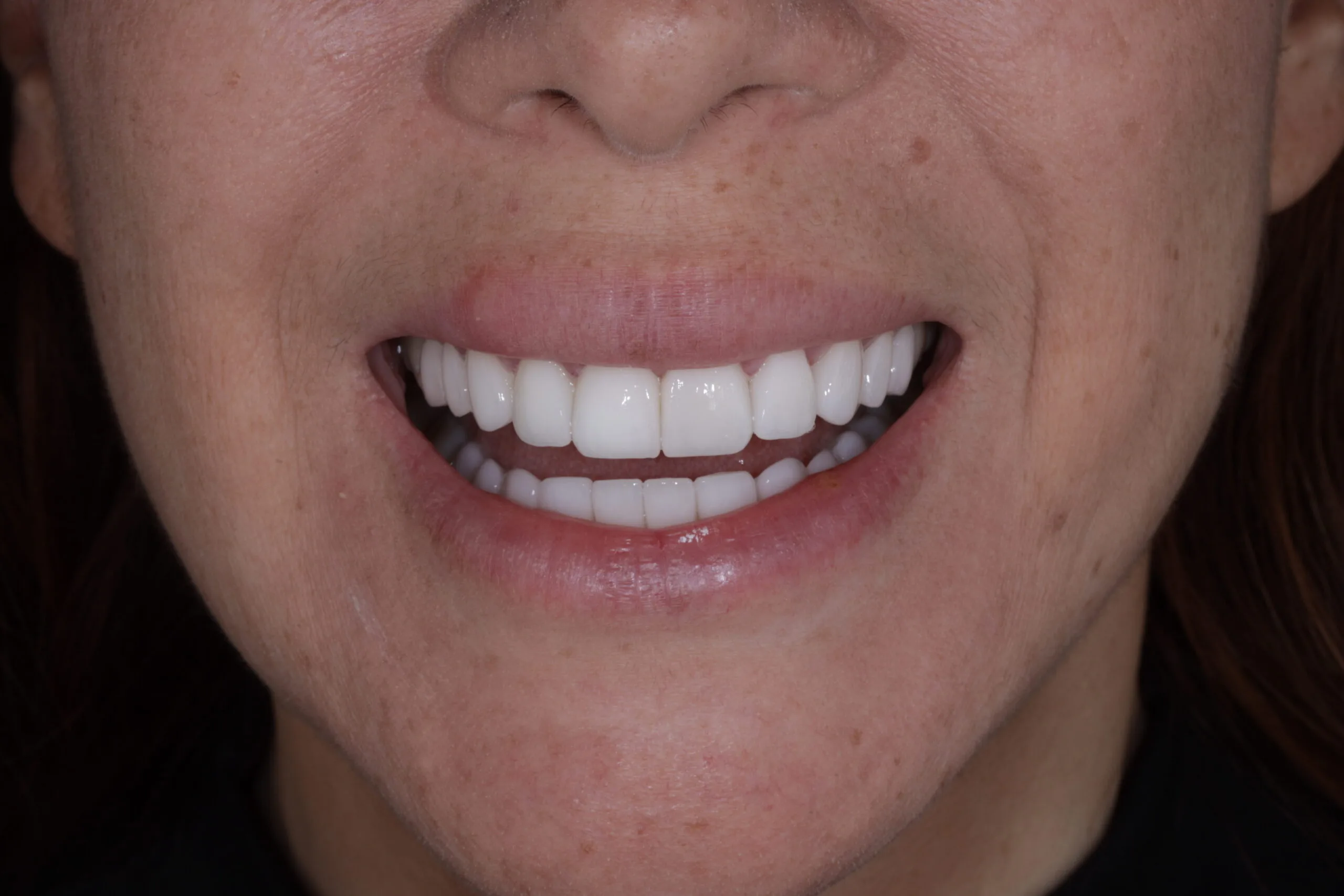 Alexandra’s Story: Aligning without braces.