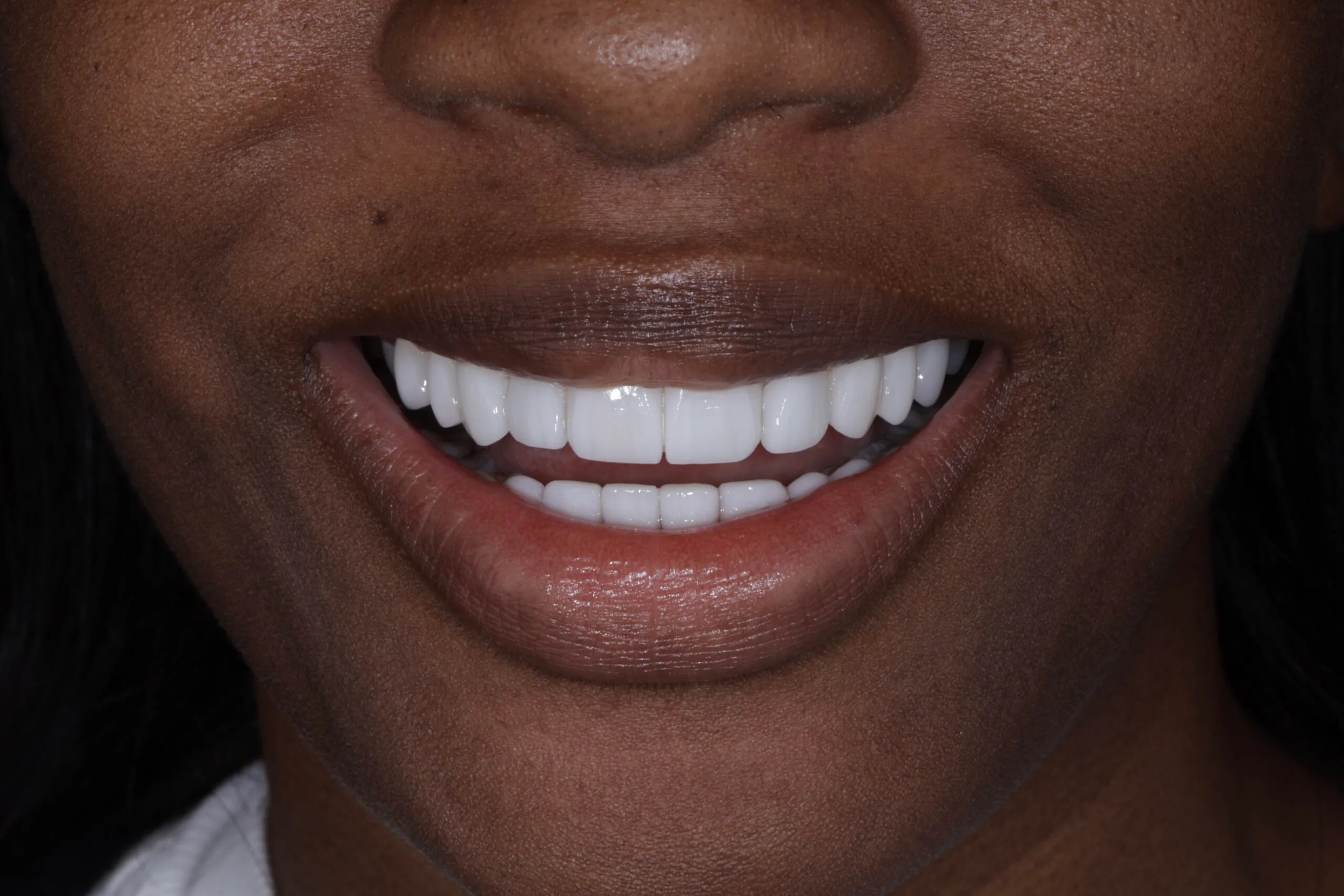 From Basic to Bold: Ashley’s Hollywood Smile