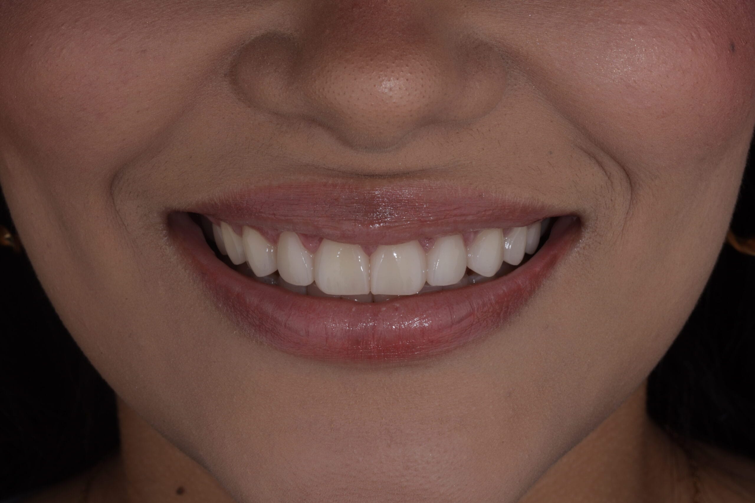 When a smile doesn’t feel like yours: Wingri’s Case