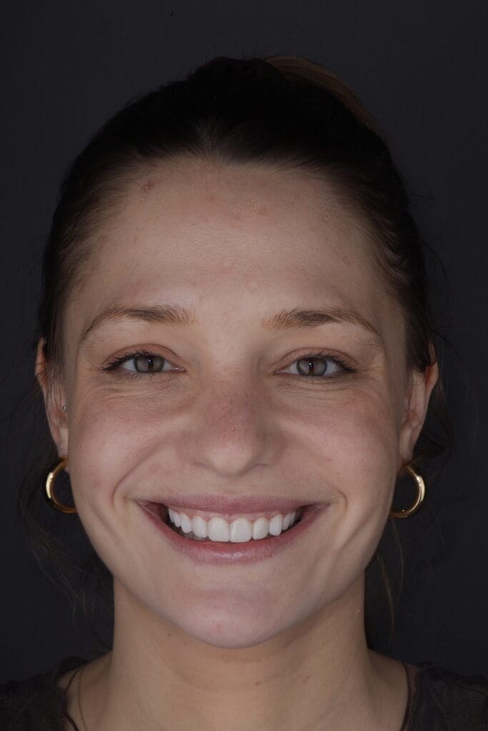 Porcelain veneers in Barranquilla patient transformation