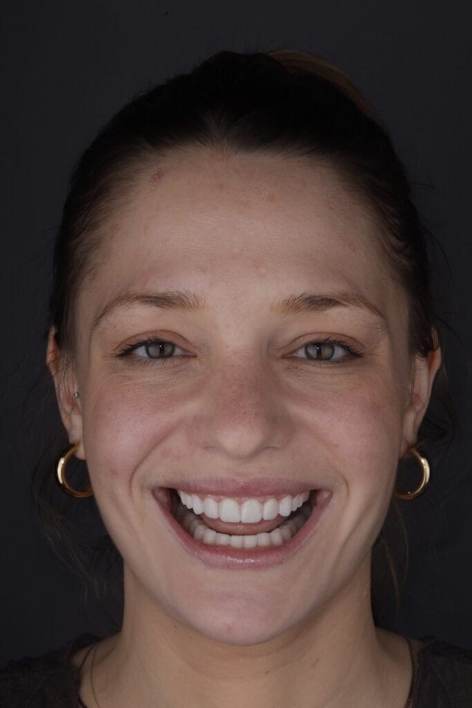 After porcelain veneers in Barranquilla