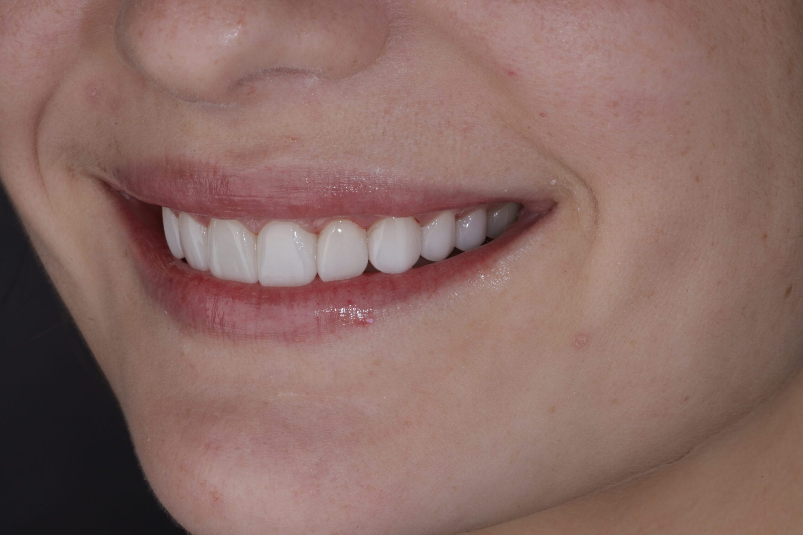 After porcelain veneers in Barranquilla 