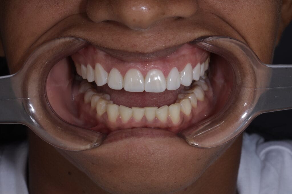 after composite veneers