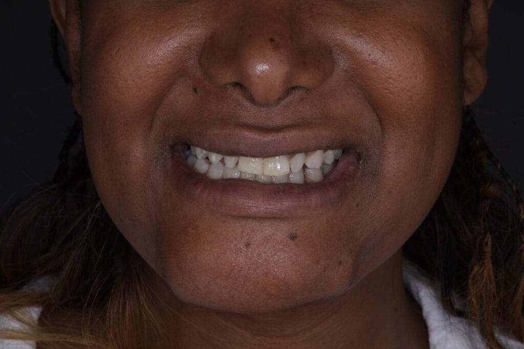Before and after ceramic veneers