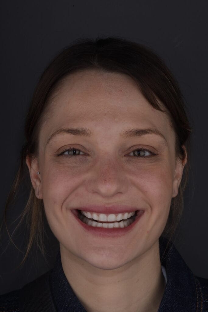 Before porcelain veneers in Barranquilla