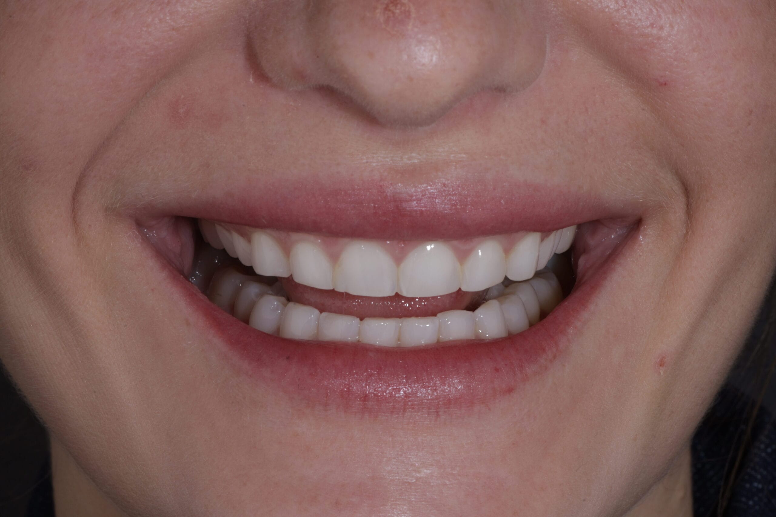 Before porcelain veneers in Barranquilla 