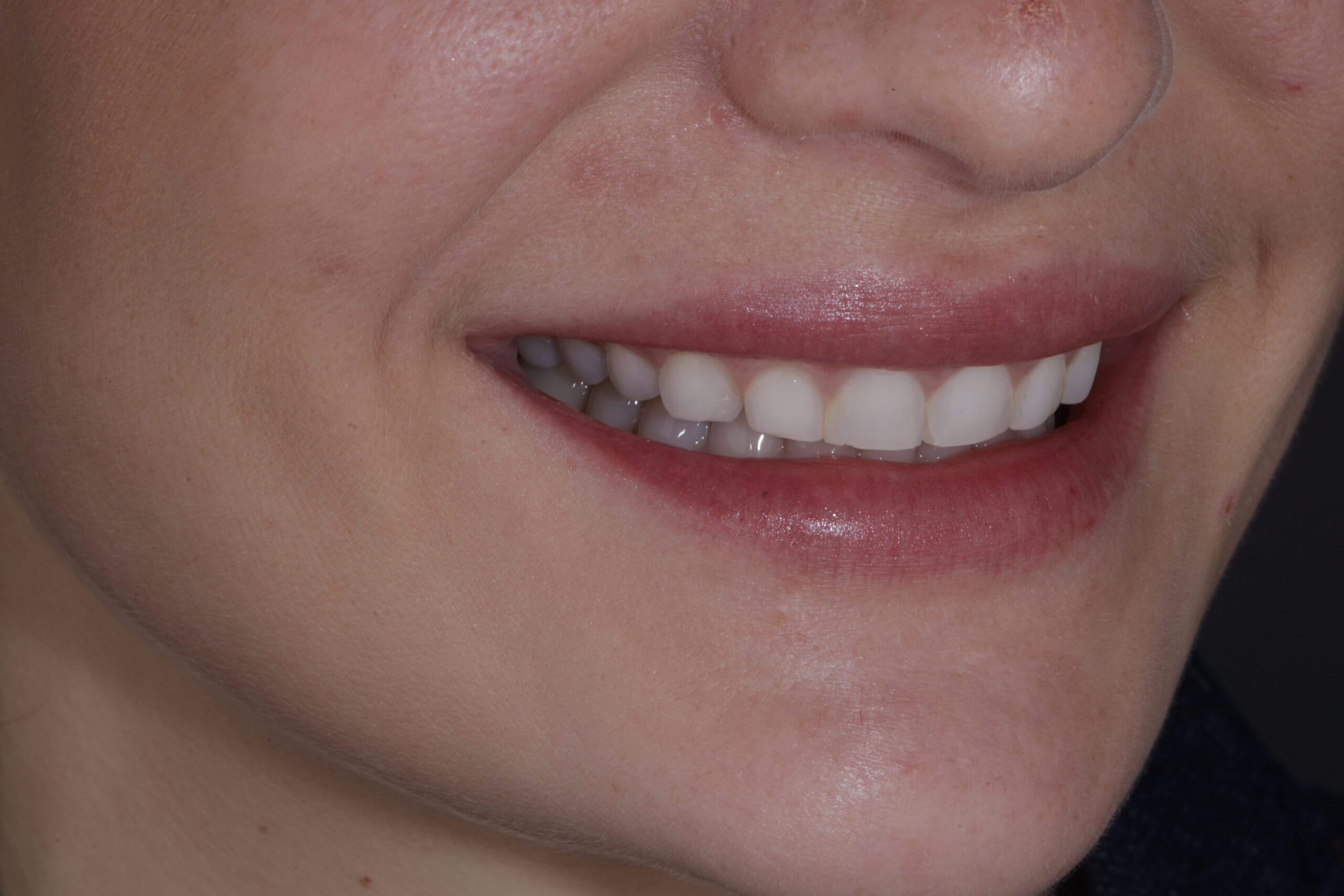 Before porcelain veneers in Barranquilla 