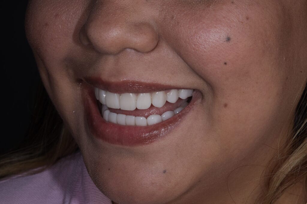 after dental veneers in barranquilla