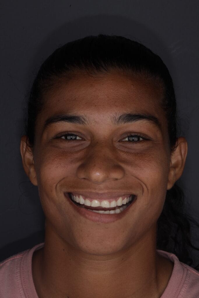 before composite veneers