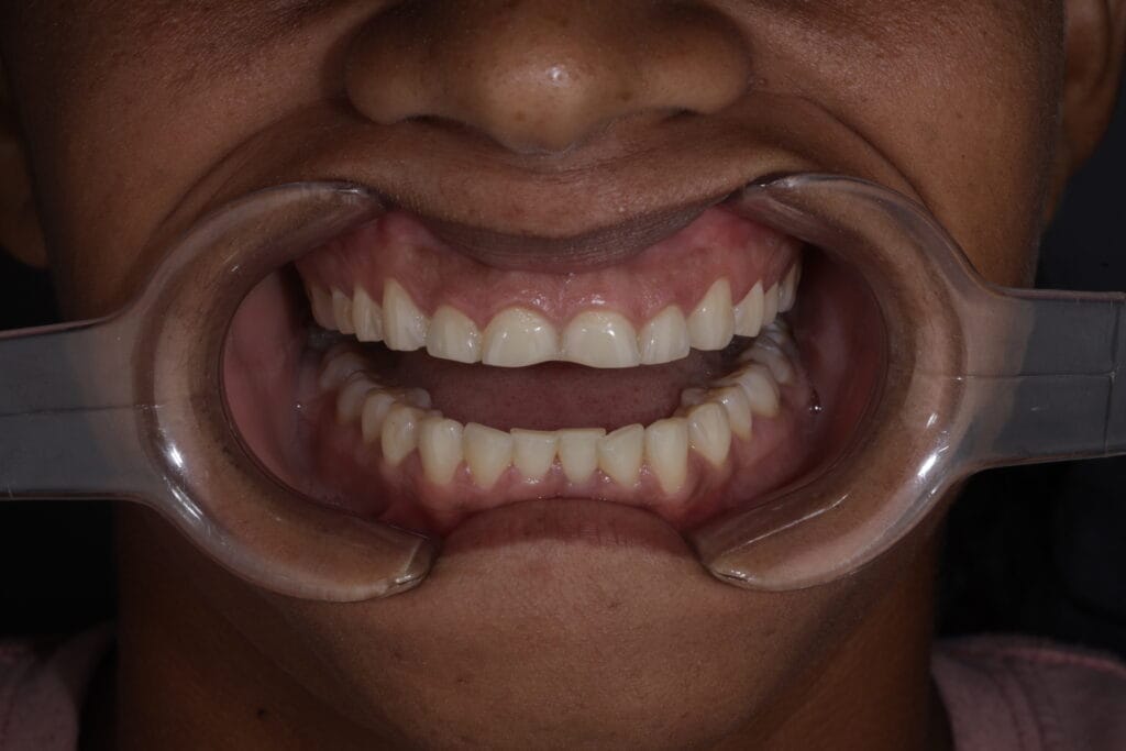 bruxism
