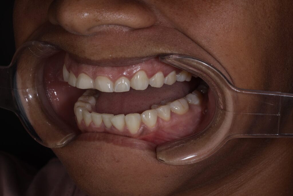 before composite veneers