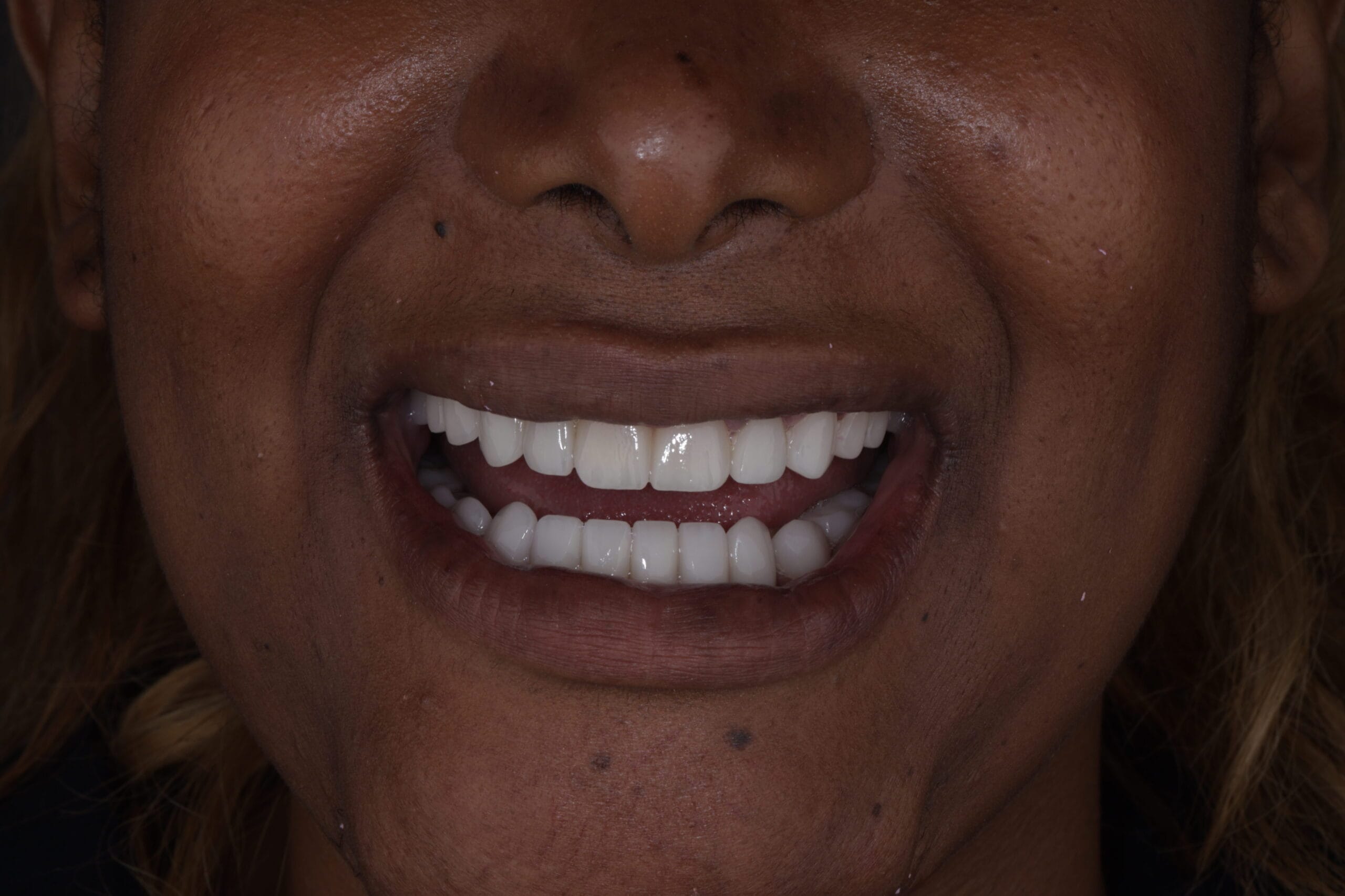 Close-up of ceramic veneers result