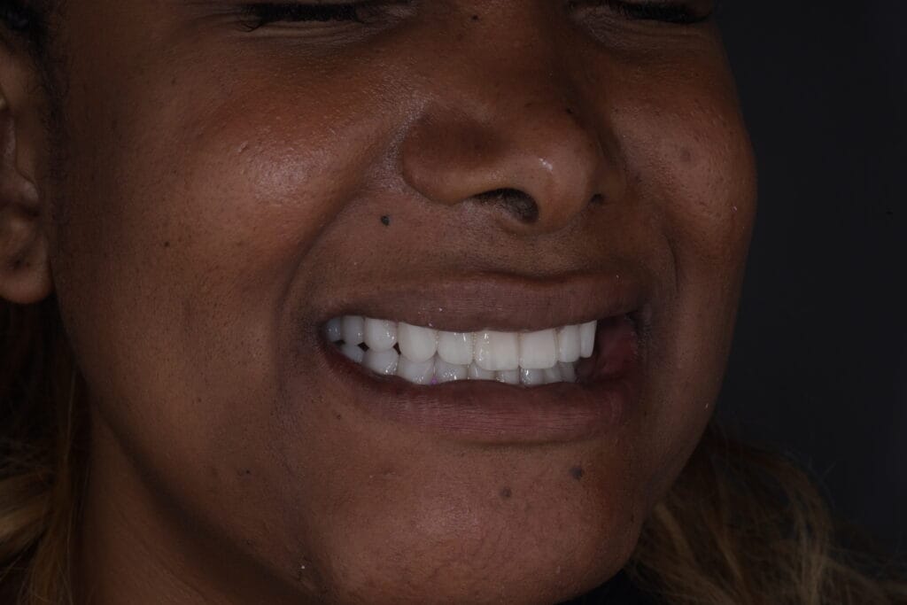Close-up of ceramic veneers result