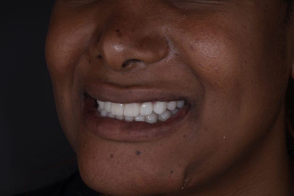 Close-up of ceramic veneers result