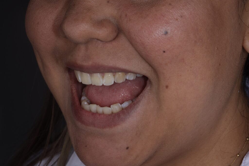 Before and after of dental veneers in Barranquilla 
