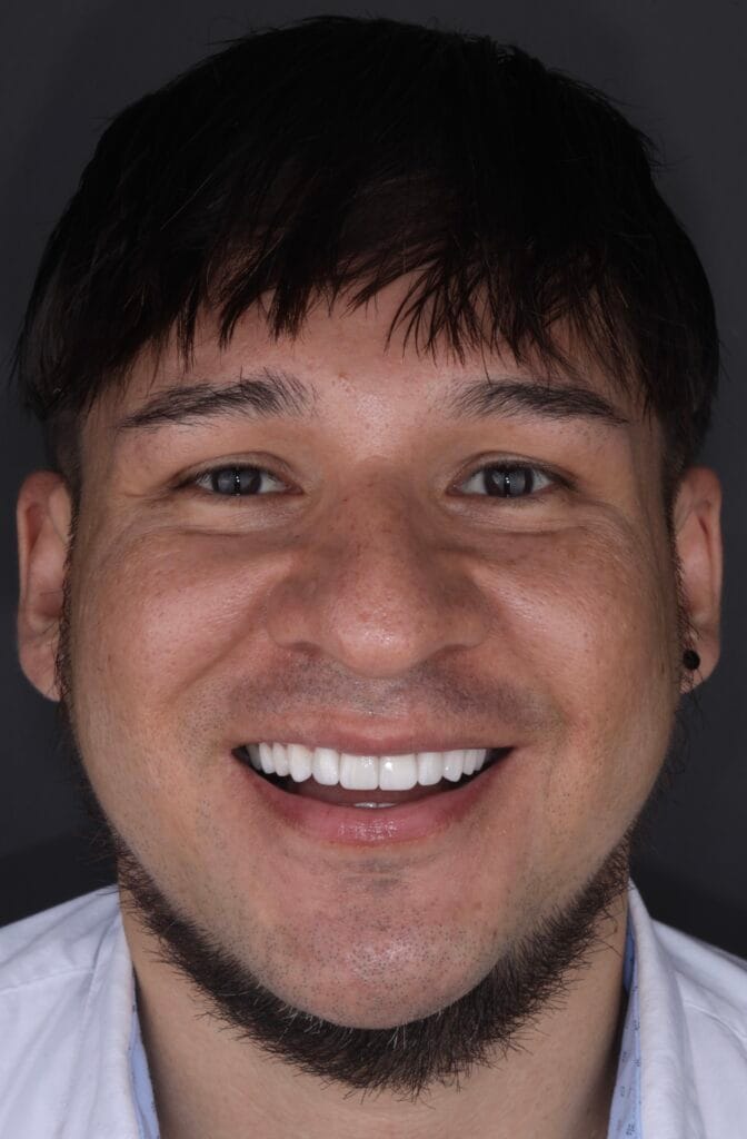 Hollywood smile without braces before and after