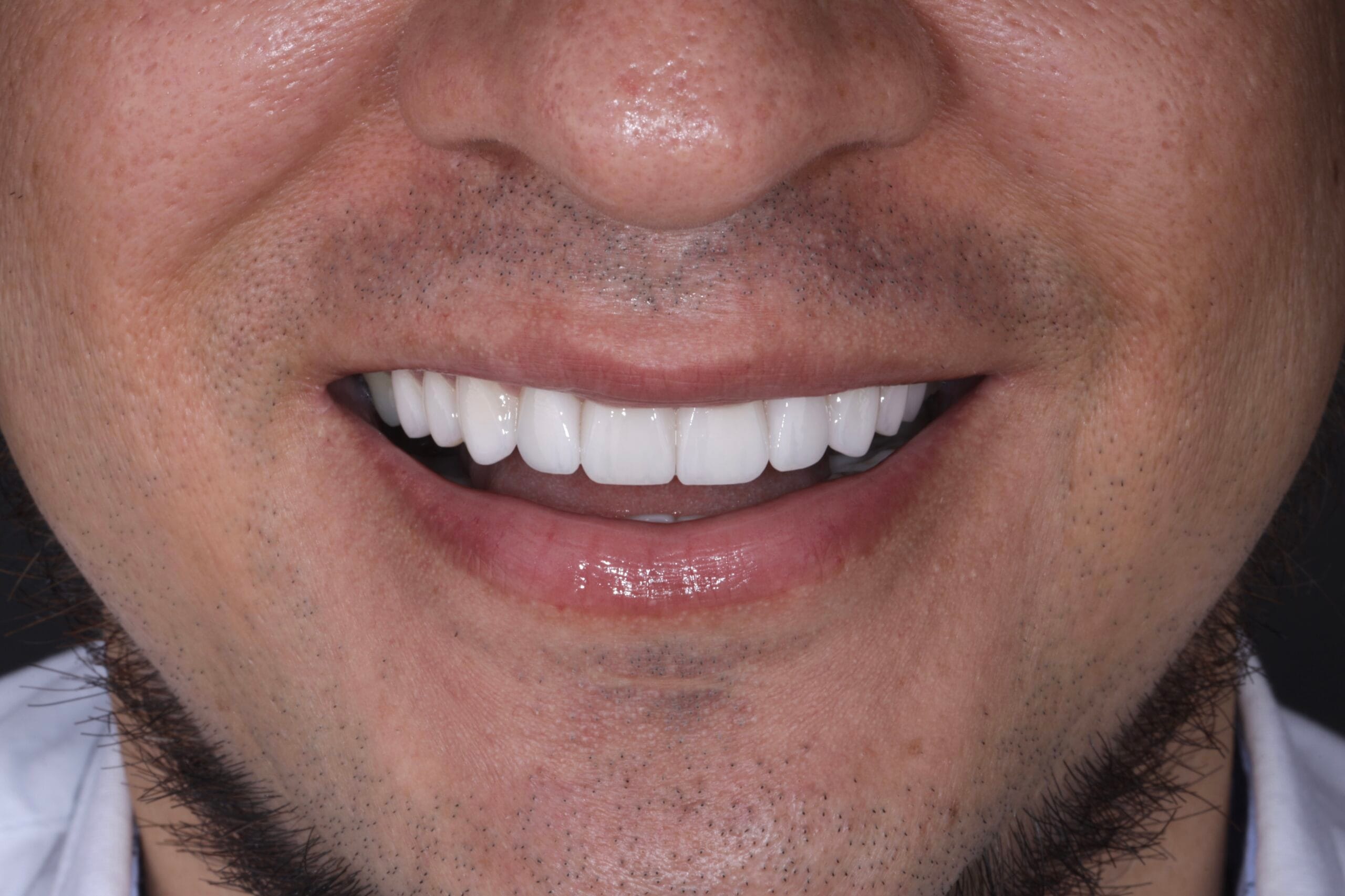 Can I Get a Hollywood Smile Without Braces?