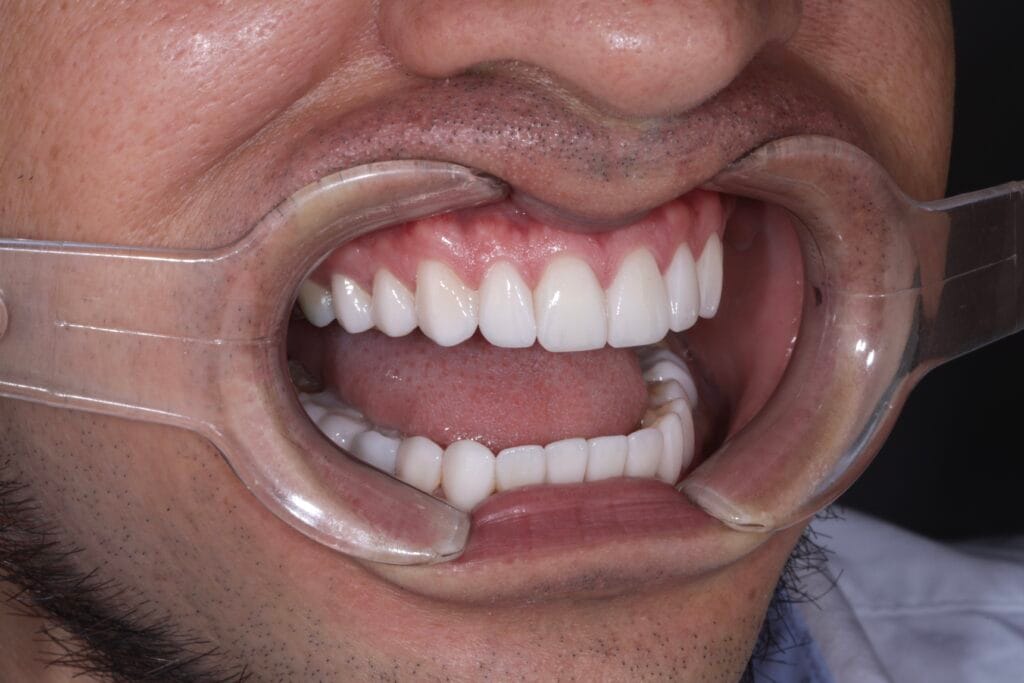 hollywood smile