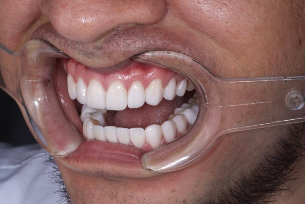 hollywood smile