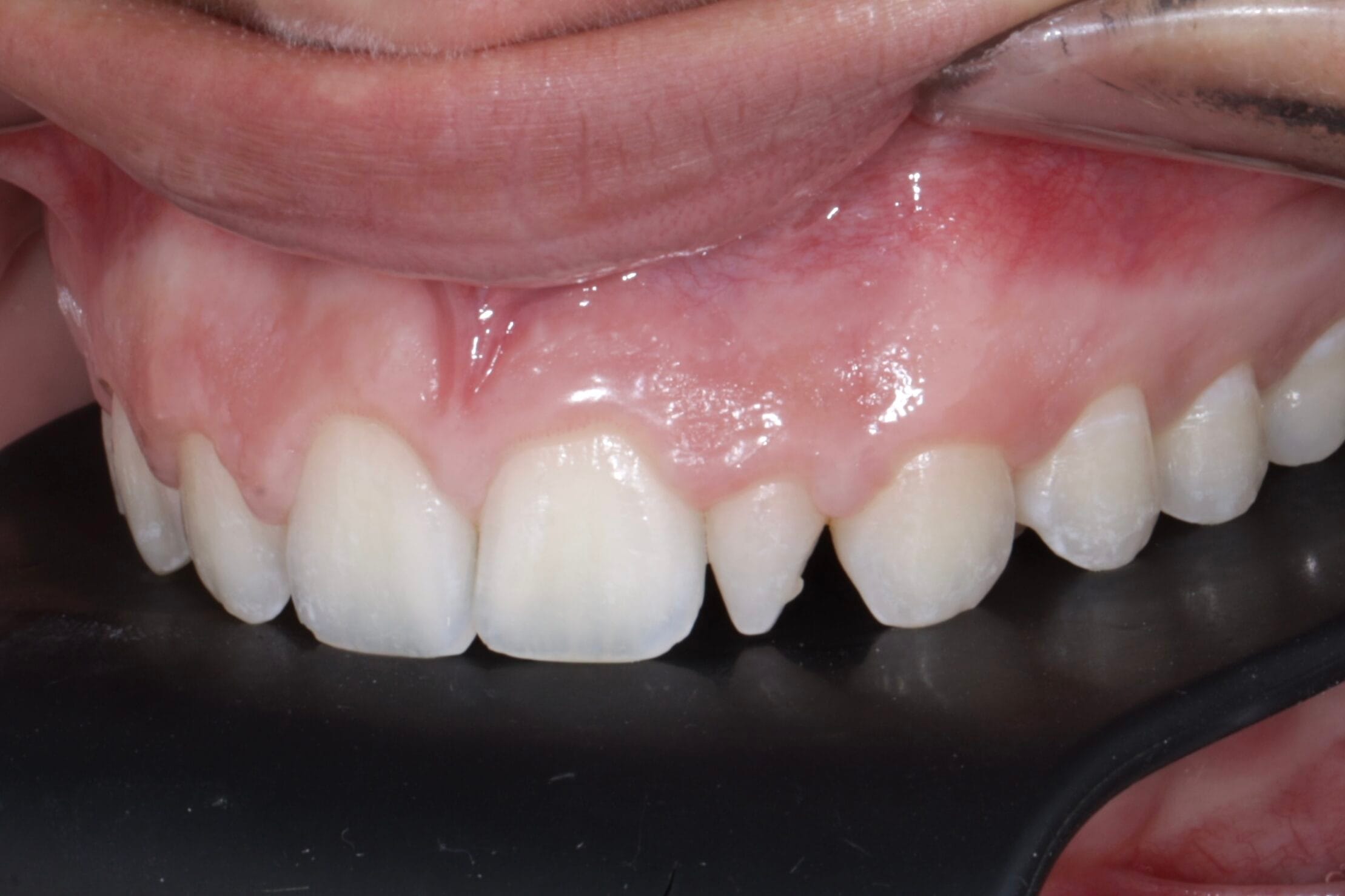 PEG TEETH