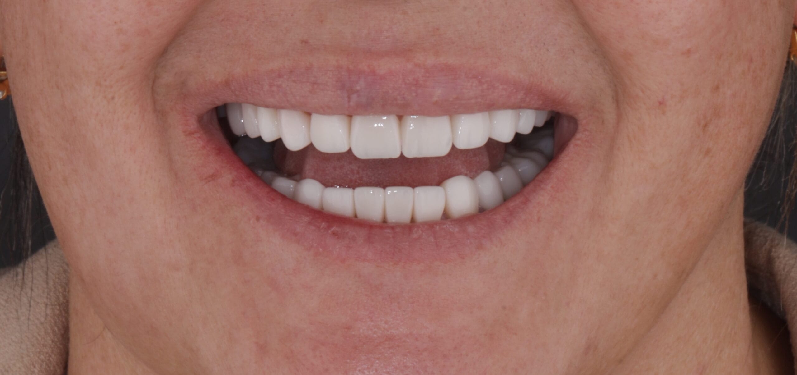 From old dental veneers and crowns transformed into a natural smile.