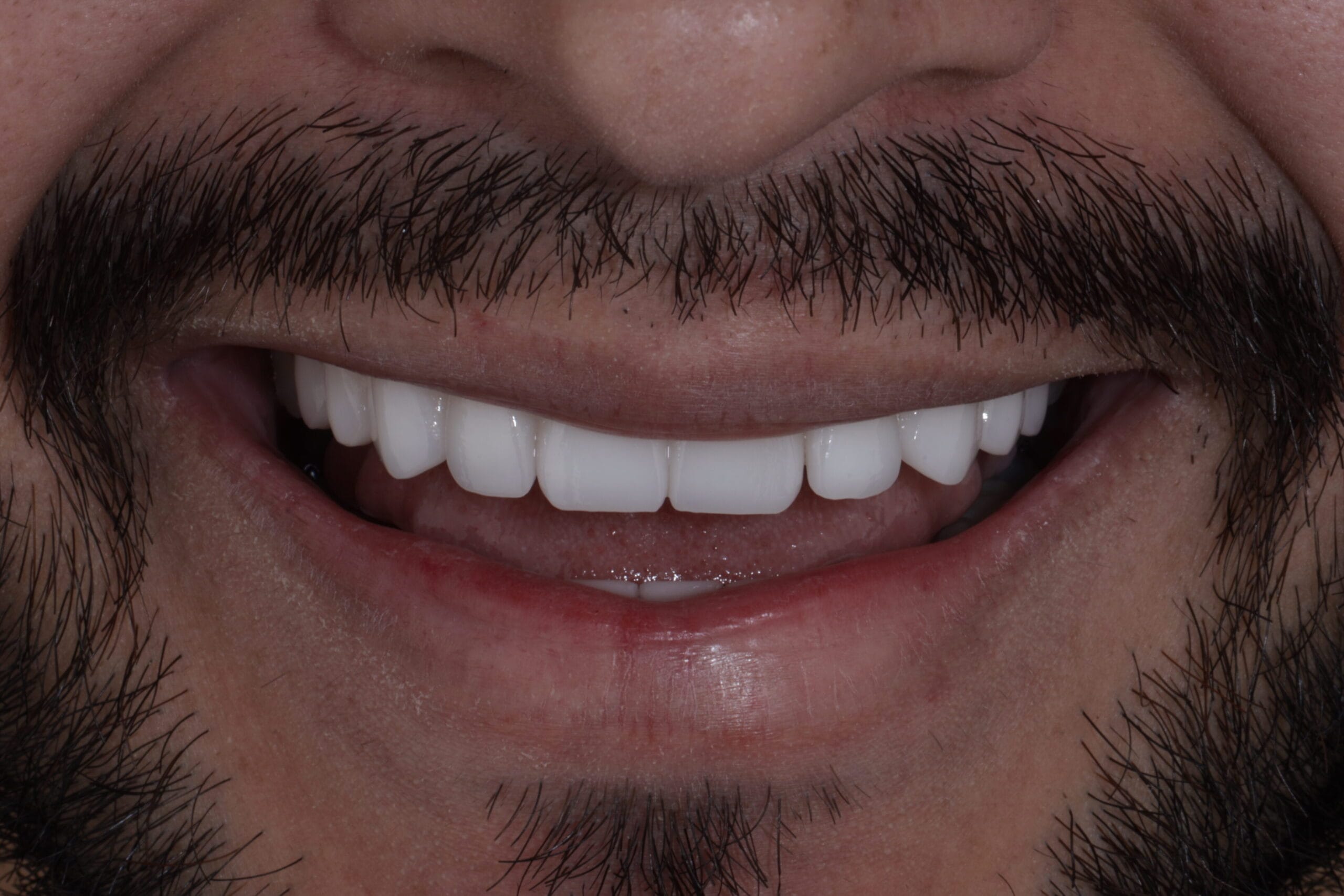 porcelain veneers