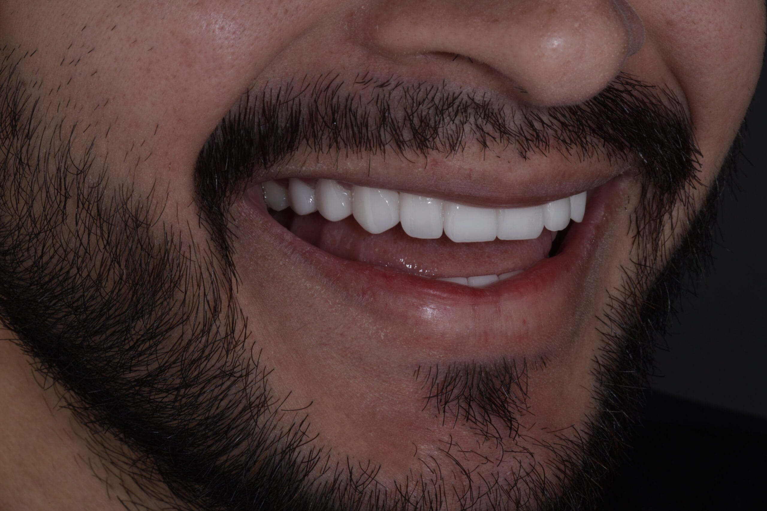 porcelain veneers