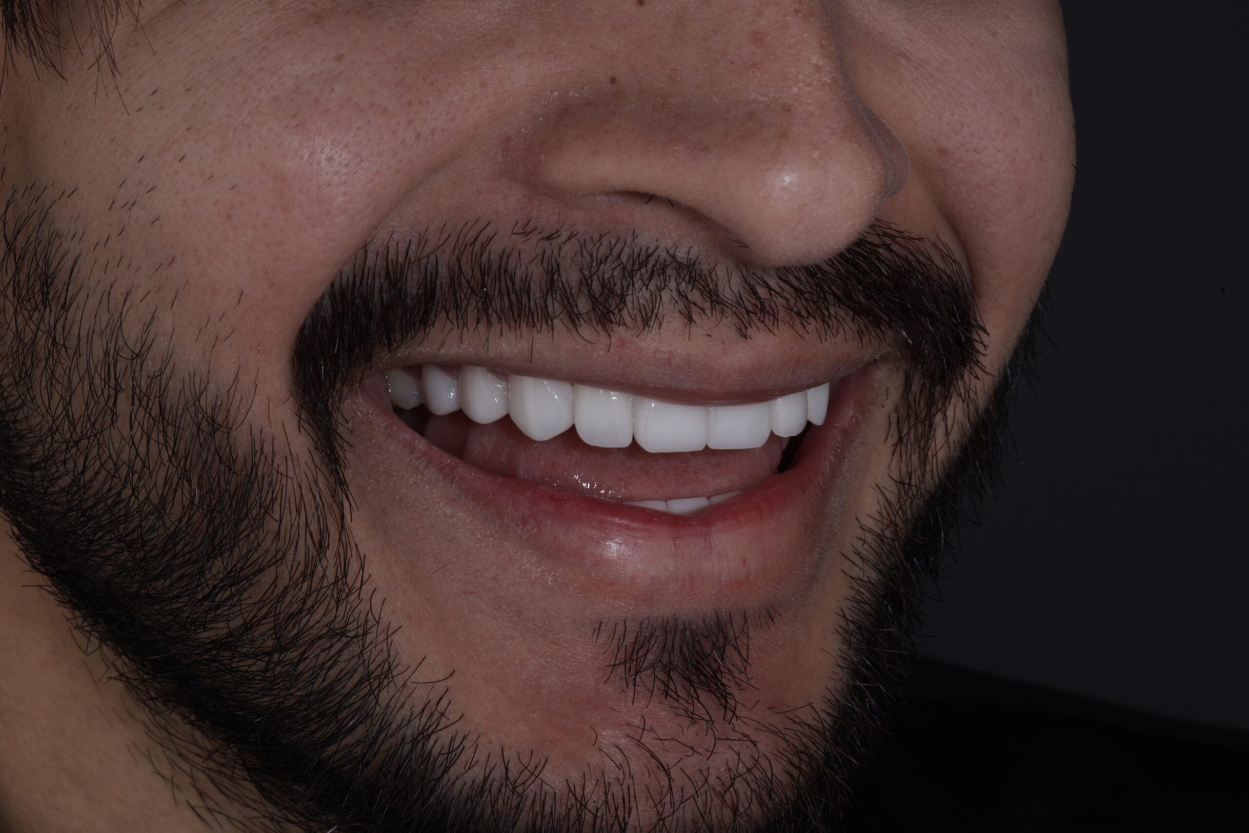 Porcelain Veneers: Upgrade from composite to ceramic