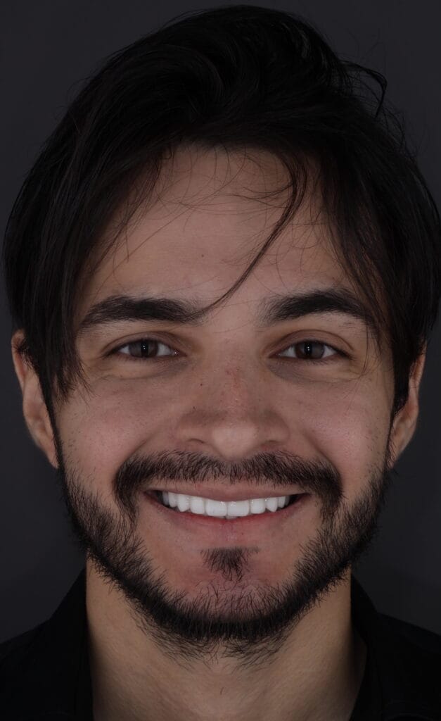 porcelain veneers