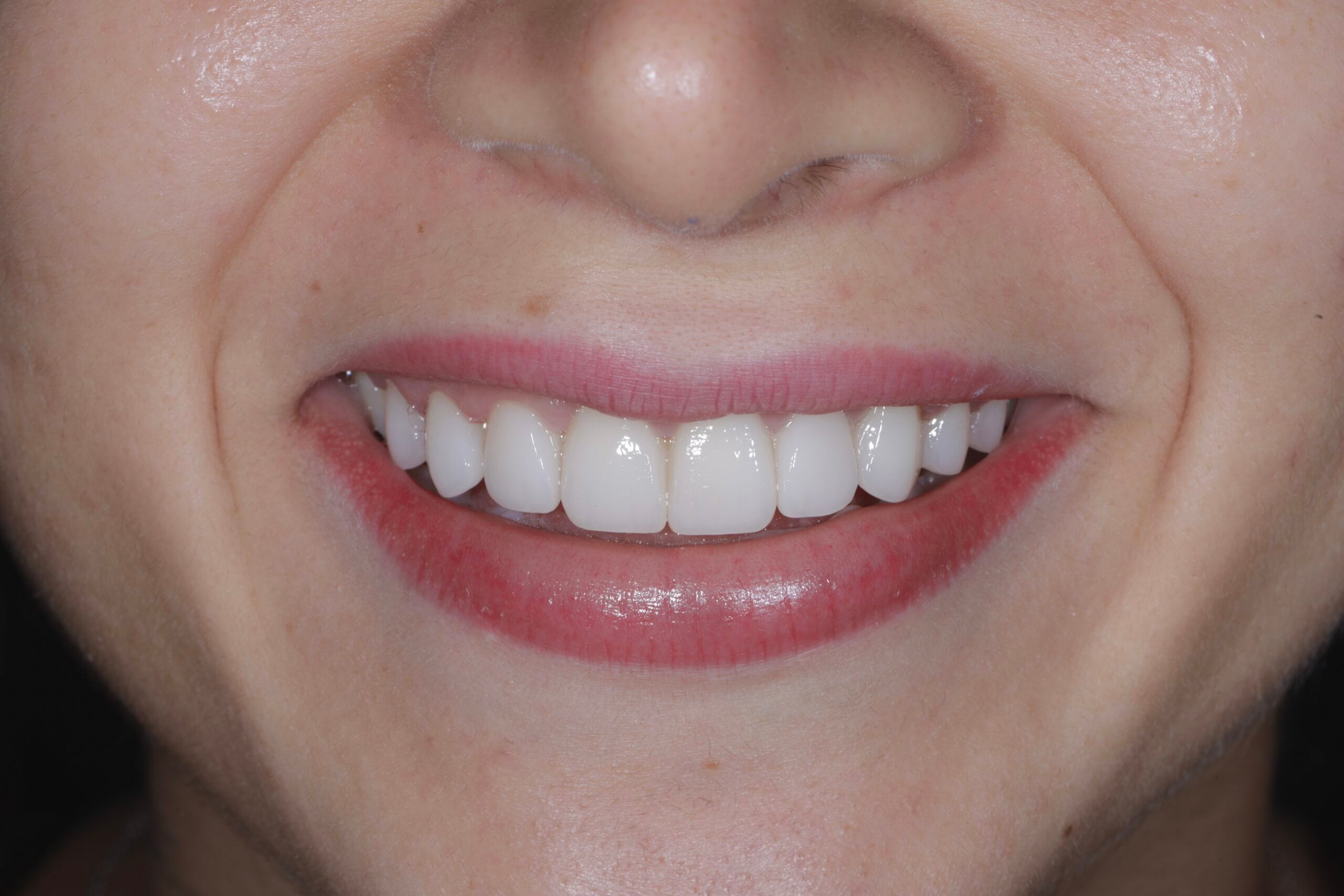 From missing one tooth to a perfect smile!