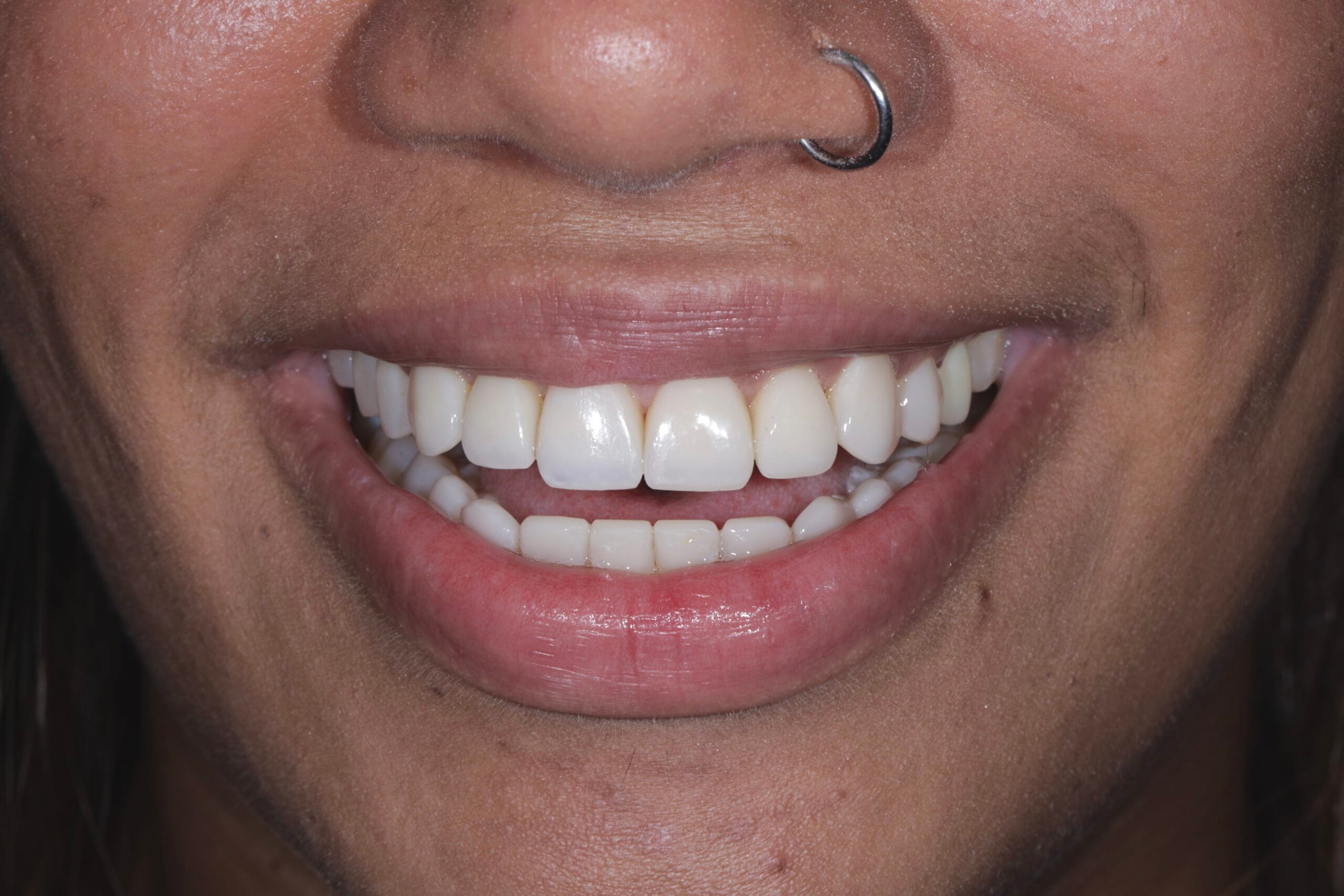 Bruxism and Masseter Hypertrophy Treatment.
