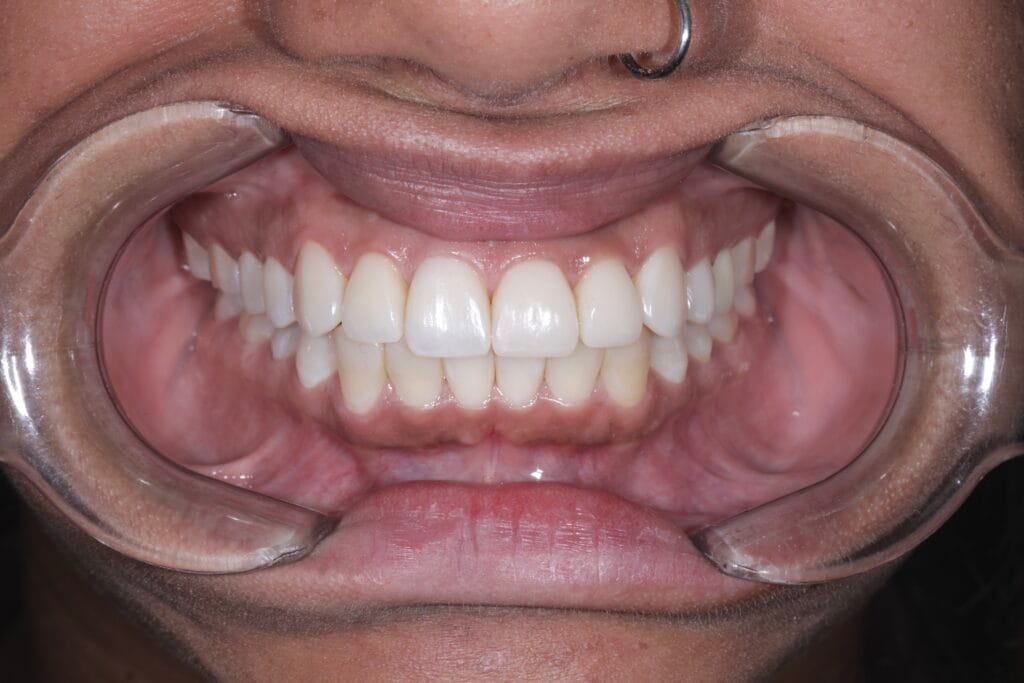 bruxism and masseter hypertrophy treatment