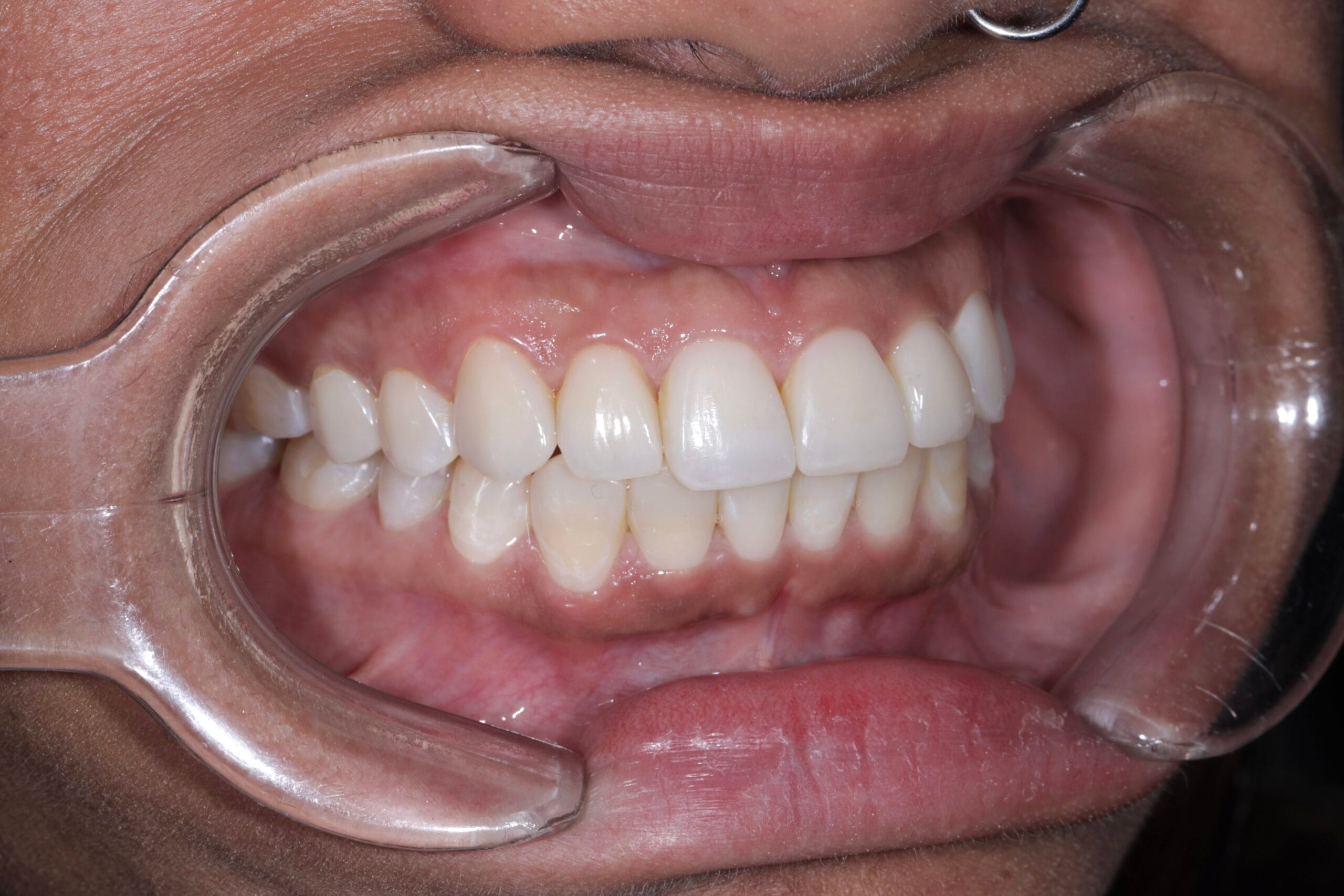bruxism and masseter hypertrophy treatment