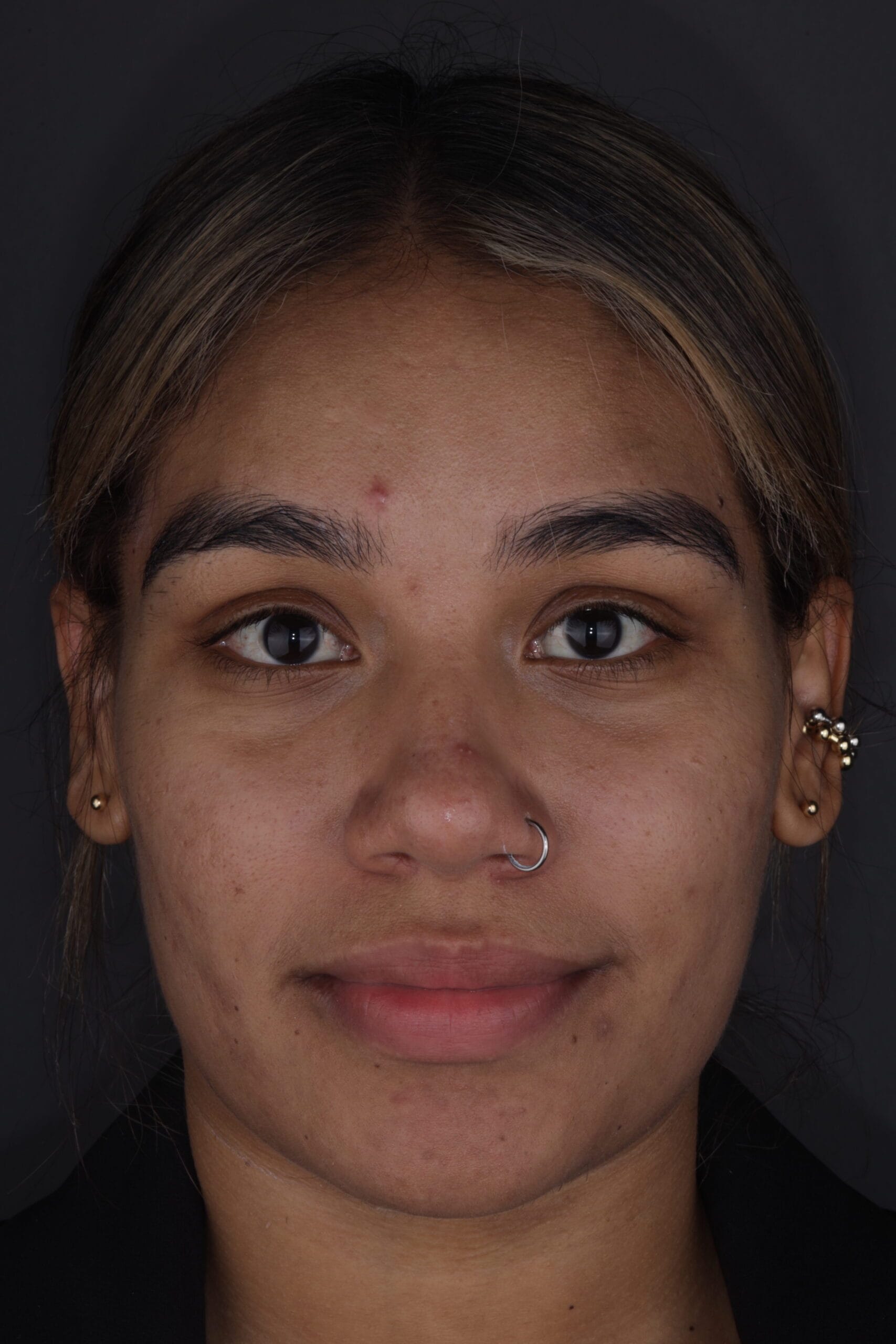 bruxism and masseter hypertrophy treatment