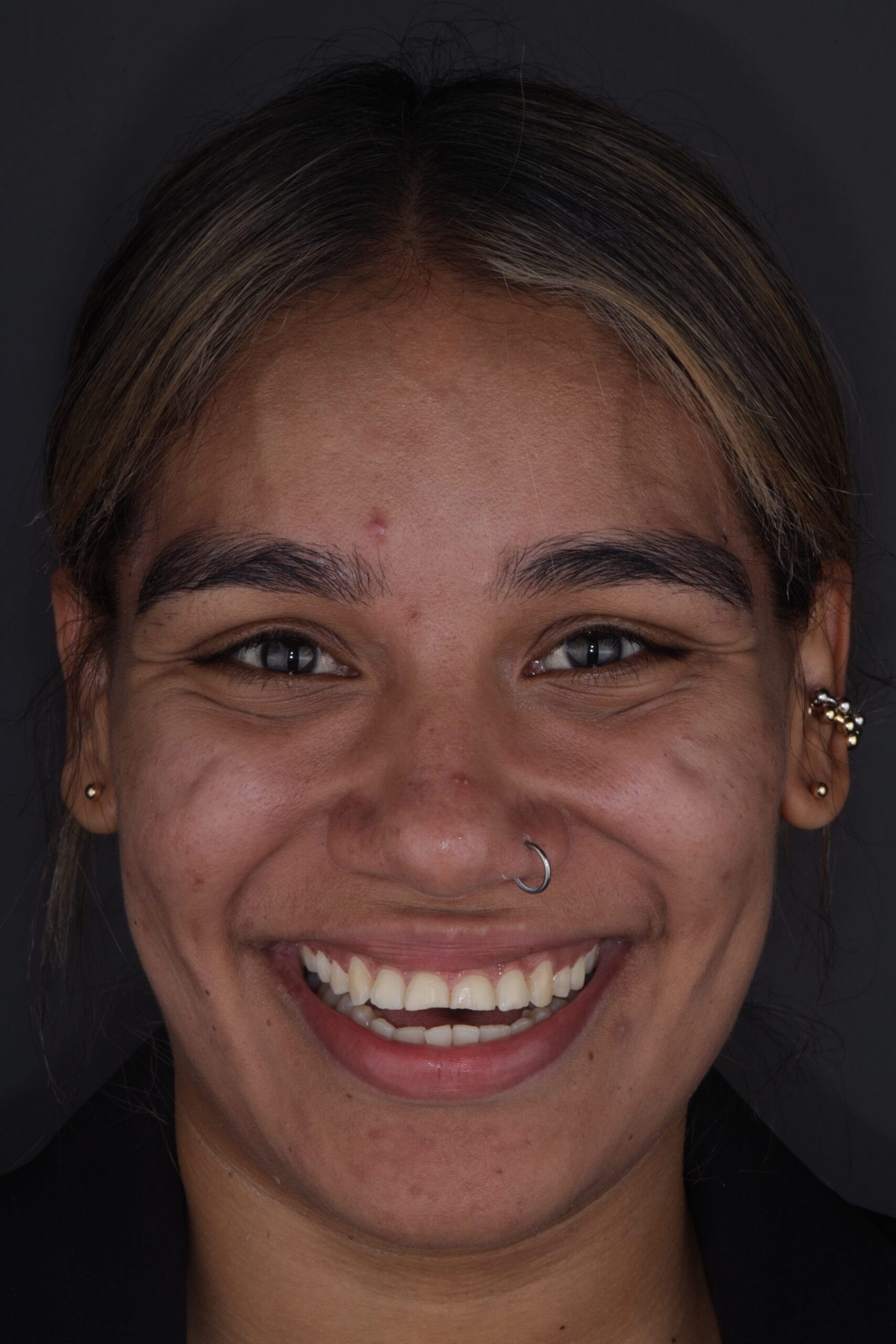 bruxism and masseter hypertrophy treatment
