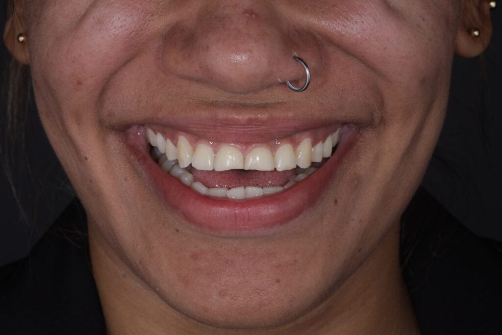 bruxism and masseter hypertrophy treatment