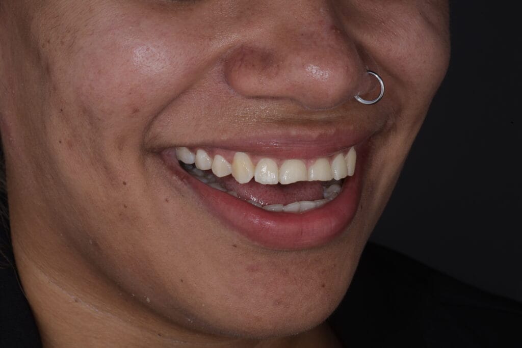 bruxism and masseter hypertrophy treatment