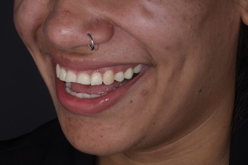 bruxism and masseter hypertrophy treatment