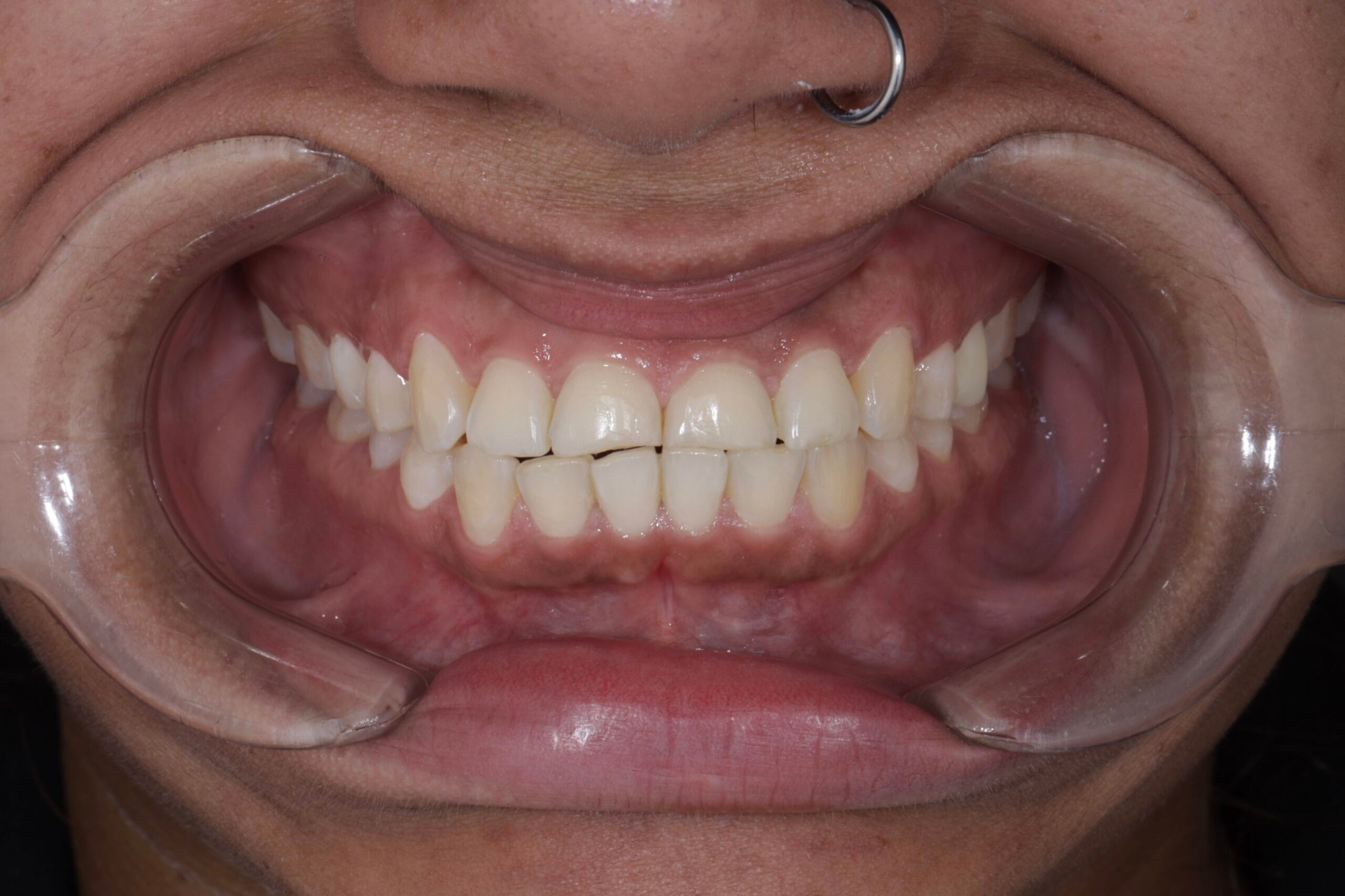 bruxism and masseter hypertrophy treatment