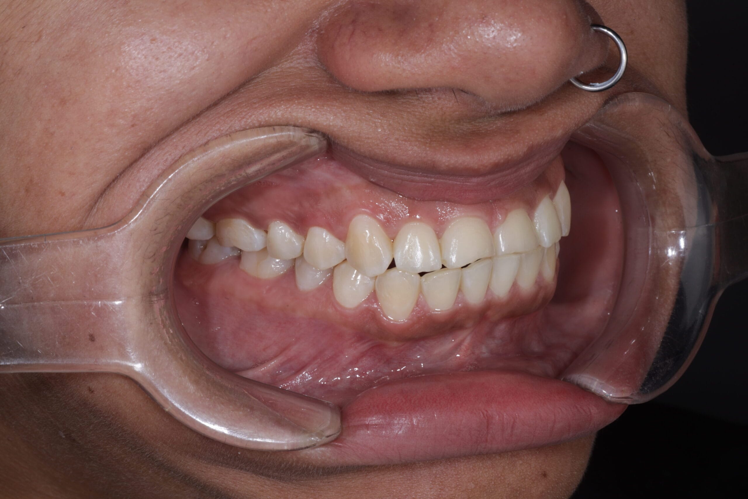 bruxism and masseter hypertrophy treatment