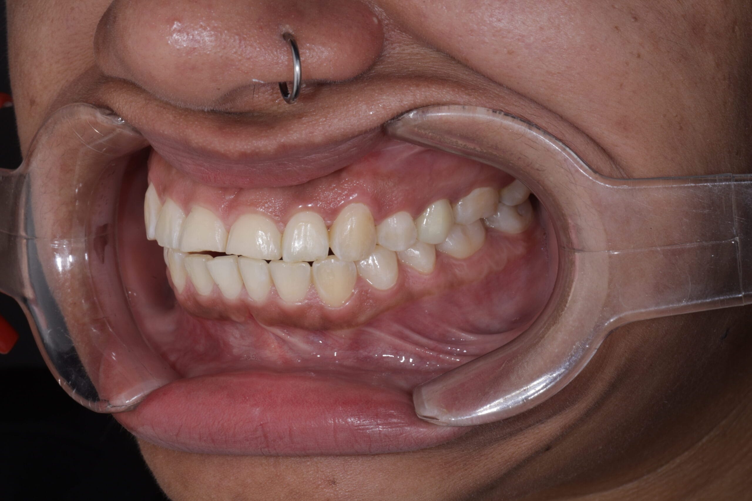 bruxism and masseter hypertrophy treatment