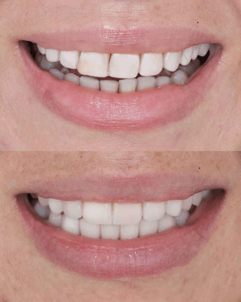 Facial analysis in smile design used to harmonize a deviated dental midline with lithium disilicate restorations
