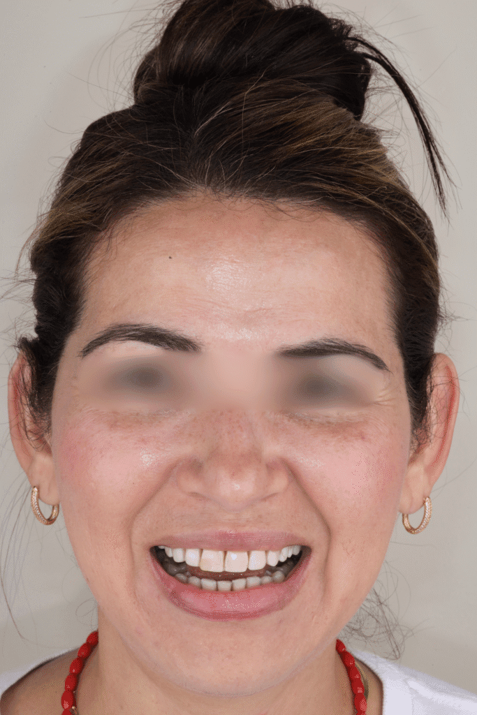 Facial analysis in smile design used to harmonize a deviated dental midline with lithium disilicate restorations