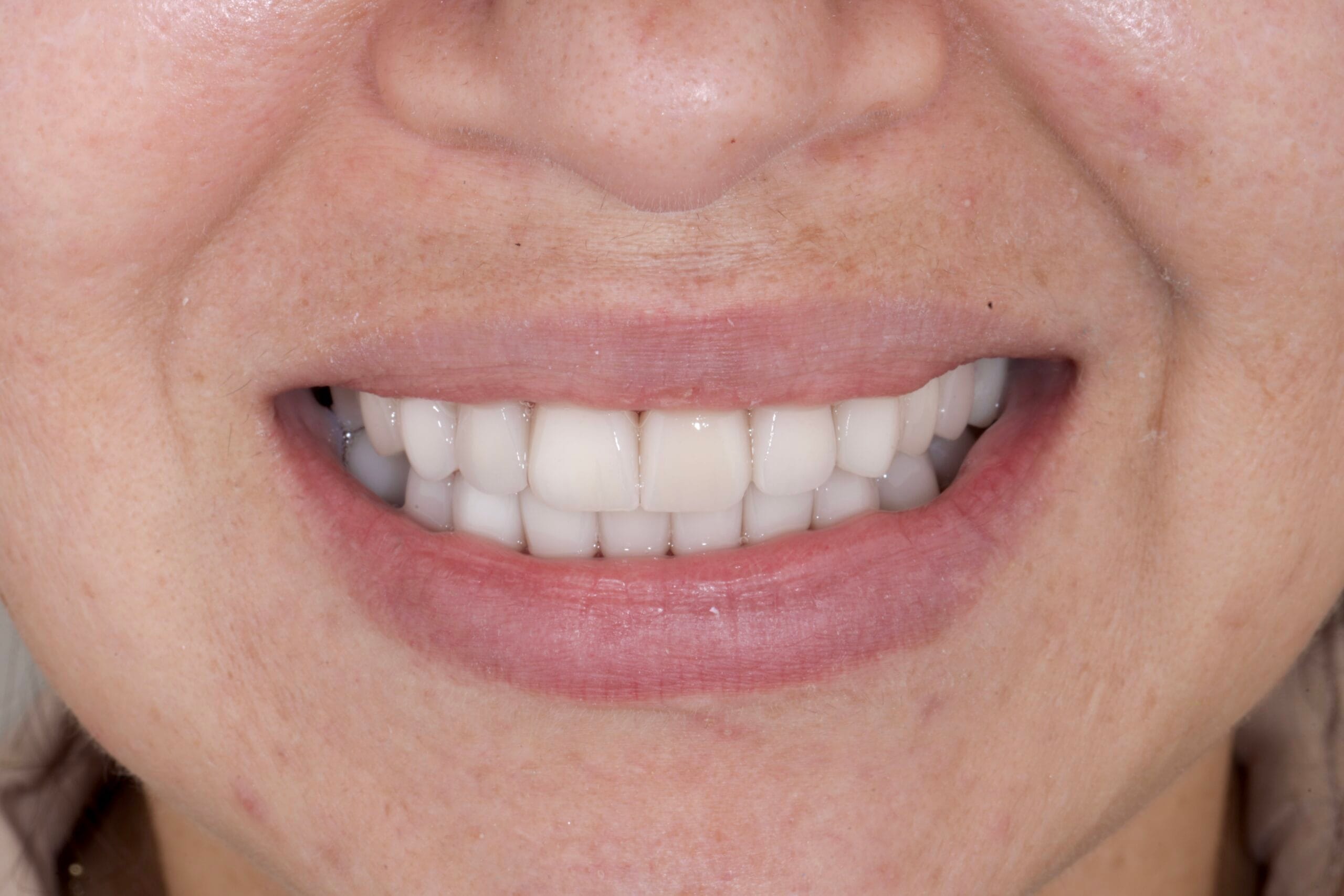 Facial Analysis in Smile Design: Managing a Deviated Dental Midline