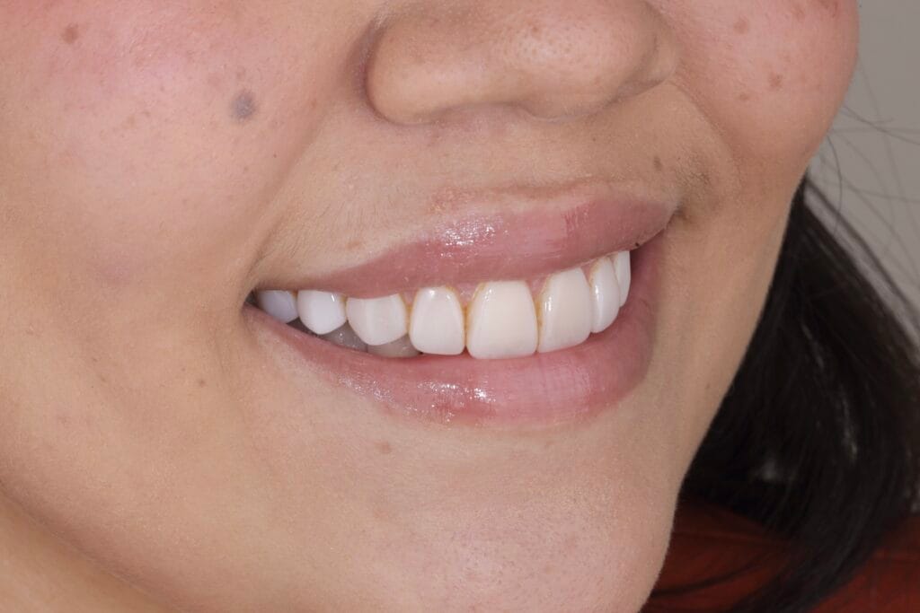Before resin veneers with staining – ceramic veneers in Colombia case
