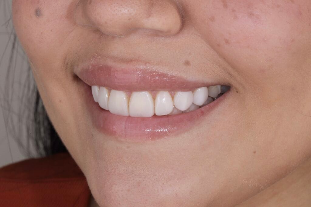Before resin veneers with staining – ceramic veneers in Colombia case